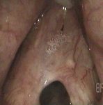 הידבקות מיתרי הקול